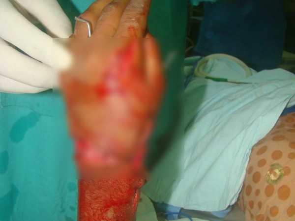 आठ घंटे की लंबी सर्जरी