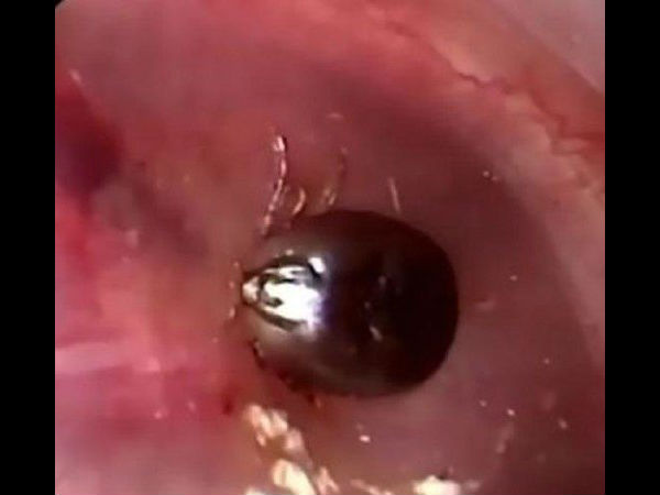  कान के अंदर था कीड़ा