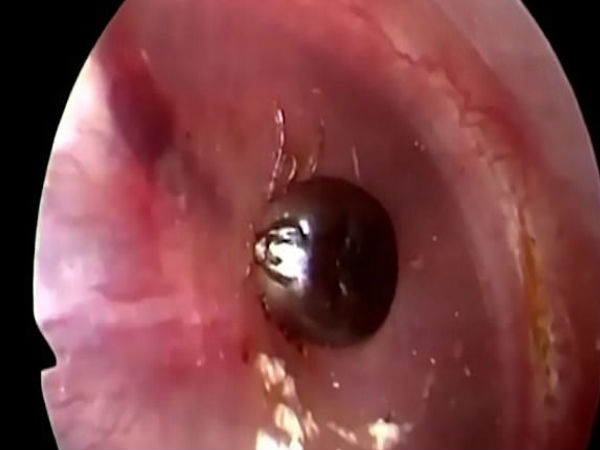  अंदर ही अंदर मांस खा रहा था कीड़ा