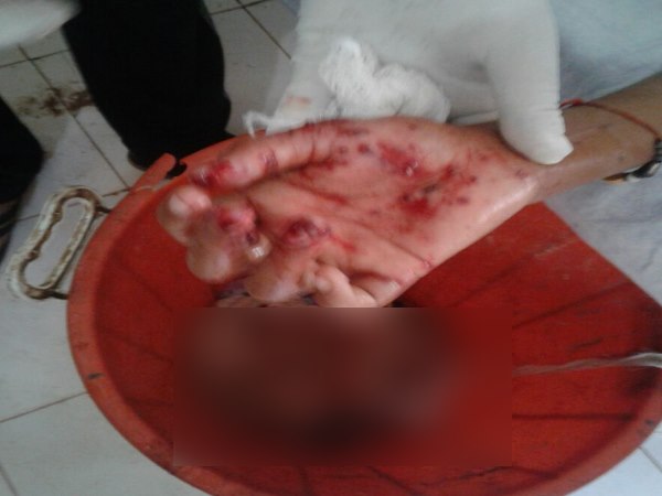 बैटरी फटते ही उंगली कट कर गिर गई नीचे