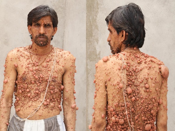 ट्यूमर से ढक गया है शरीर