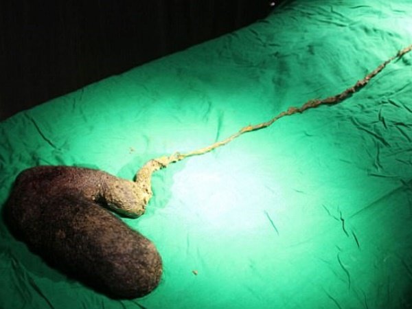 750 ग्राम बाल खा चुकी थी