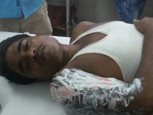 बरेली में 19 लोग झुलसे