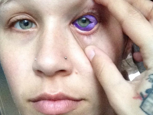 डॉक्टर ने बोला, निकालनी पड़ेंगी आंखें