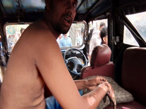  तेजाब से जला हाथ