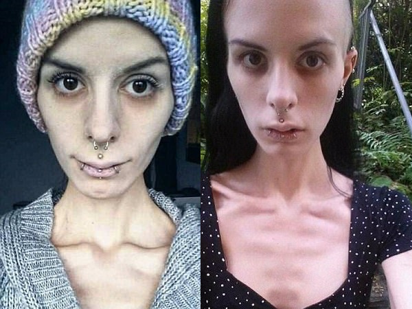 हड्डियों का ढांचा लगने लगीं थीं जूलिया