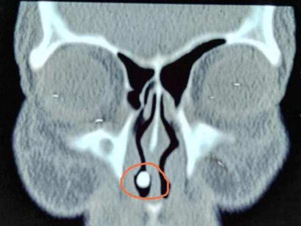 नाक में उगे दांत देख डॉक्टर्स भी हैरान