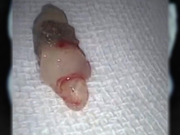 बचपन से मौजूद था दांत