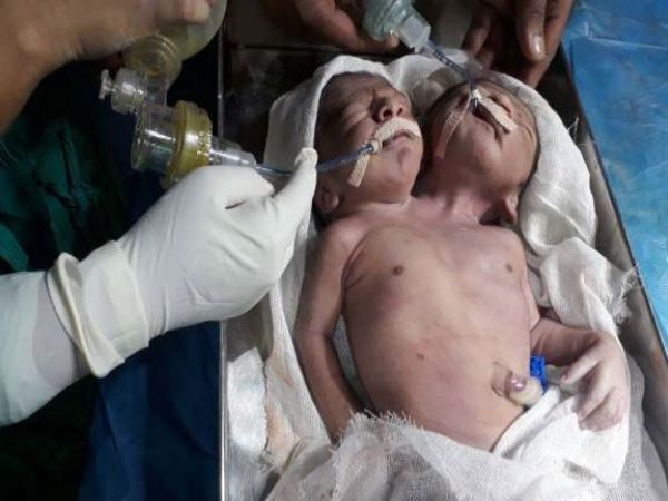 Double head child shock everybody but all is good Double head child shock everybody but all is good