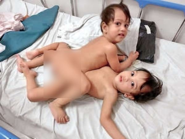 1 साल 3 माह बाद किया गया ऑपरेशन