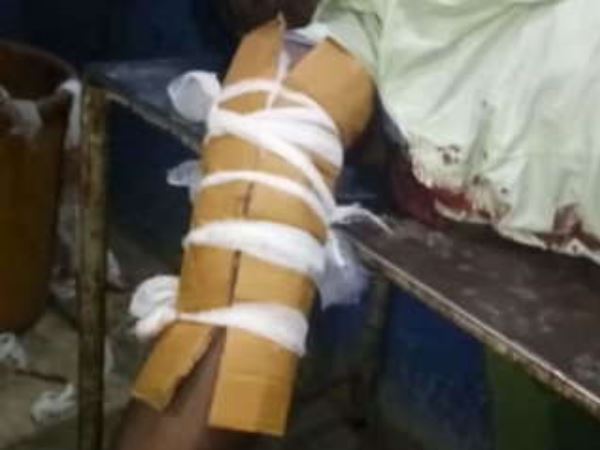  प्लास्टर की जगह बांध दिया कार्टन