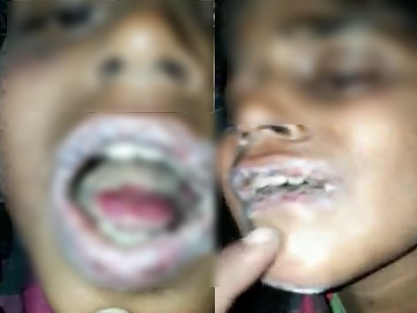 31 जनवरी को पहले पिलाया पिलाया था नहीं मरा तो 5 फरवरी को फिर से पिलाया