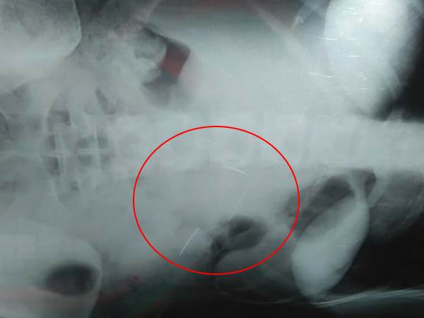 नसबंदी के ऑपरेशन में डॉक्टर का कारनामा