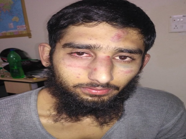 पिटाई में छात्र को काफी चोट आई हैं