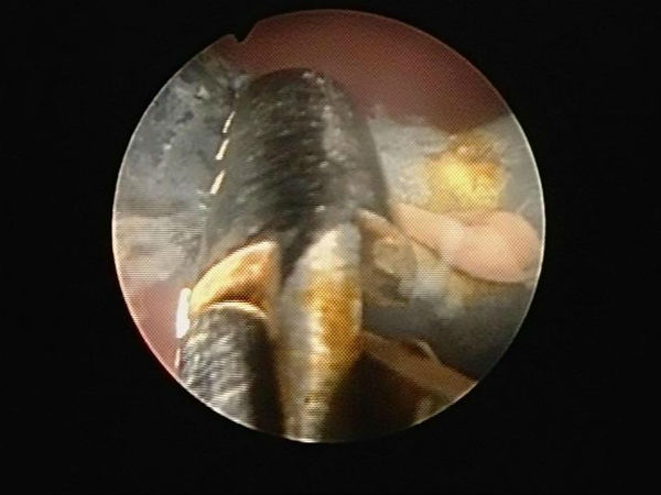 ऑपरेशन के बाद बची जान