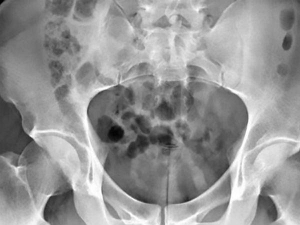 मजे के चक्कर में पहुंचा अस्पताल