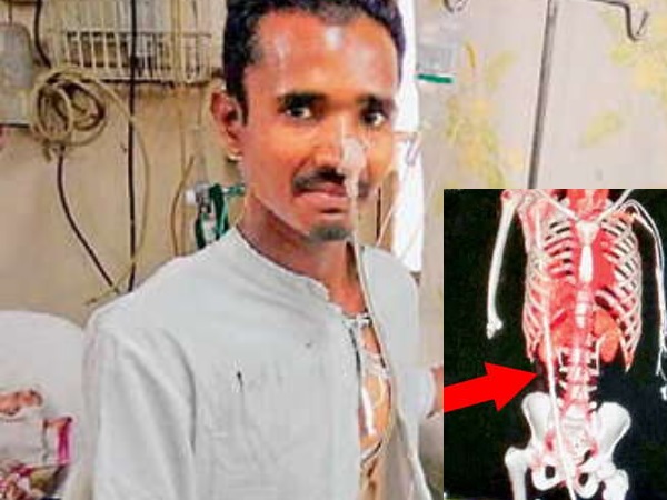 9 फीट नीचे स्लैब पर गिरा और प्राइवेट पार्ट के पास घुस गया सरिया