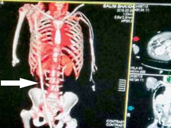 10 डॉक्टरों ने 5 घंटे तक ऑपरेशन कर निकाला सरिया