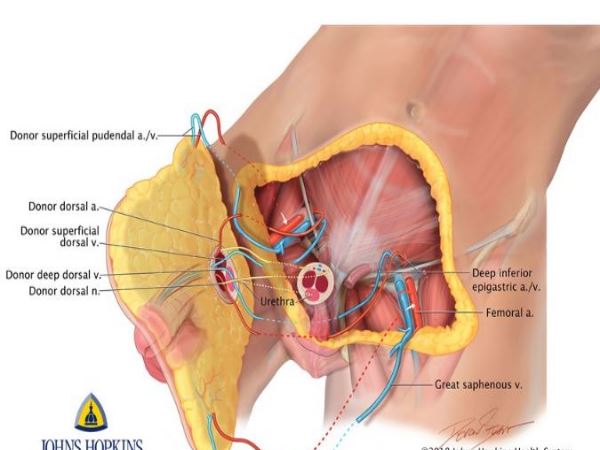 पहले भी हो चुके लिंग ट्रांसप्लांट