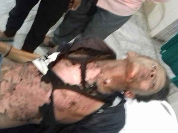 Electricity scorching the young man in the wake of selfie