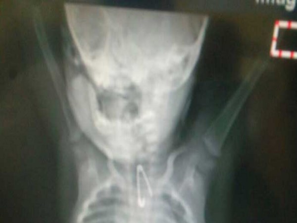 किडनी भी प्रभावित