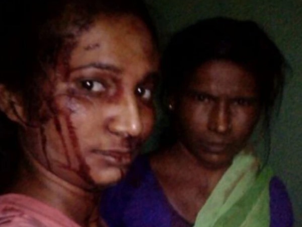 रुपाली की मां ने गहने बेच कराया इलाज रुपाली की मां ने गहने बेच कराया इलाज