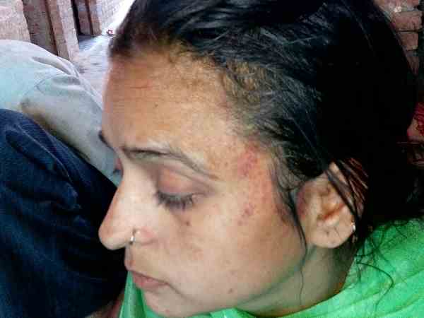 पूरे शरीर पर चोटों के निशान