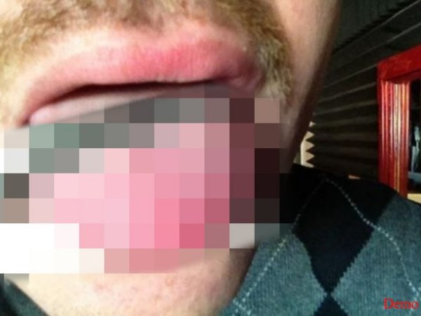 हादसे में एक छात्र की जीभ कटकर गले में फंसी 