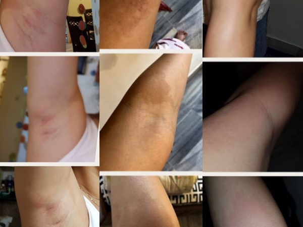 जल गई सुमोना की स्किन