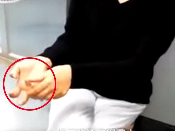  फोन की वजह से टेढ़ी हो गई उंगलियां 