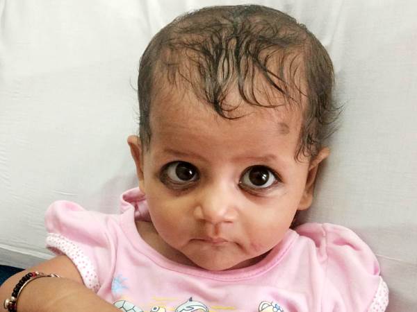 11 महीने की शिवानी की सर्जरी के लिए नहीं है मां-बाप के पास पैसे
