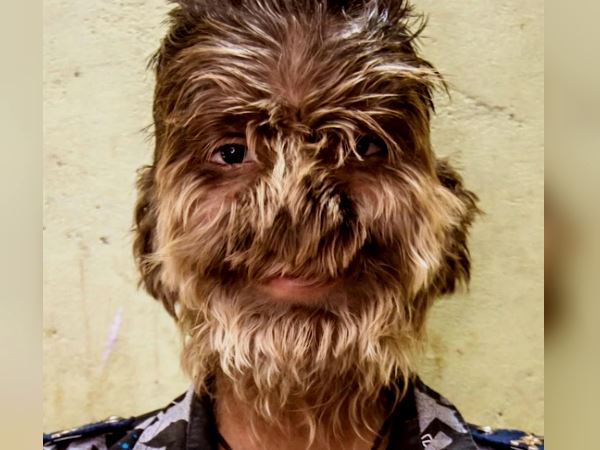 hairs on entire face of 13 year old boy lalit patidar in Ratlam Madhya pradesh hairs on entire face of 13 year old boy lalit patidar in Ratlam Madhya pradesh