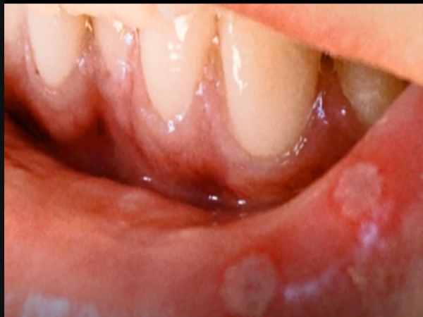 Rajkot, Gujarat, Broken glass, glass found in medicine, Intas Pharmaceuticals Ltd, राजकोट, इंटास फार्मा लिमिटेड, मलहम