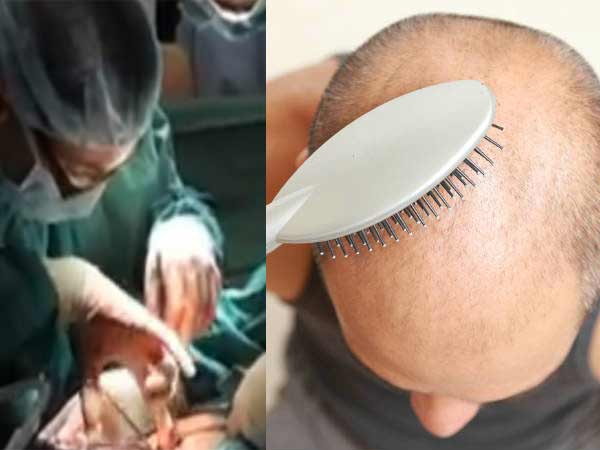 बेहद पतले हो गए थे बाल
