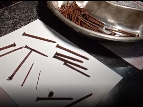 115 Nails of iron come out from patients stomach in Bundi Rajasthan