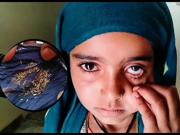 Jaisalmer Girl Suffering from Rare diseases of Eyes Jaisalmer Girl Suffering from Rare diseases of Eyes