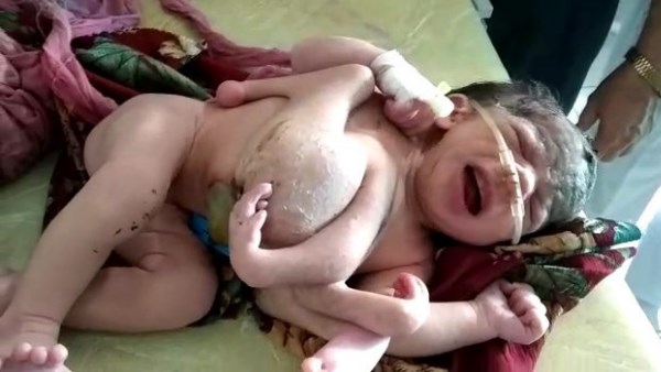 Four handed child born in Malpura CHC Tonk Rajasthan