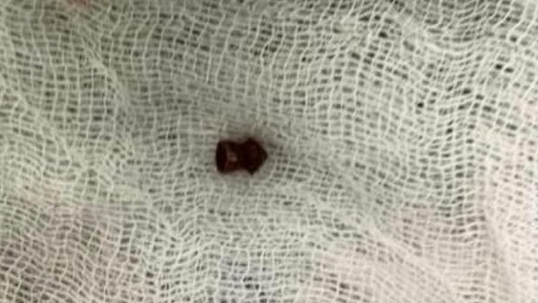 2 years girl baby shots by her brother, doctors saves life