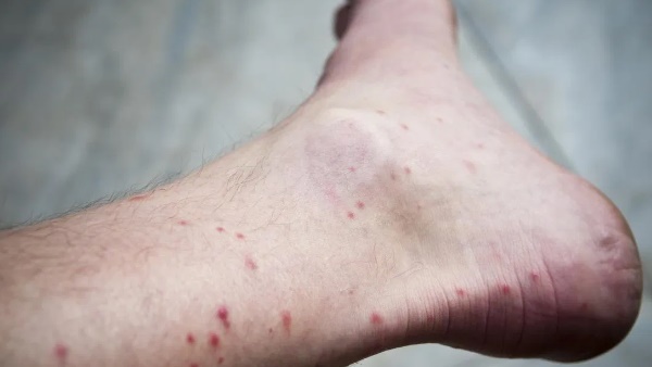 ये हैं डेंगू के लक्षण