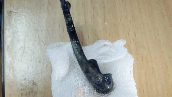 फेफड़े में फंसा था पेन का ढक्कन