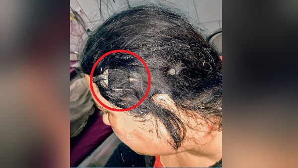 डॉक्टरों ने निकाली गोली