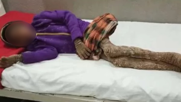 एक मस्से से हुई बीमारी की शुरुआत 