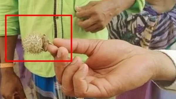 TikTok पर वायरल हो रहे वीडियो से अपनाया था उपचार