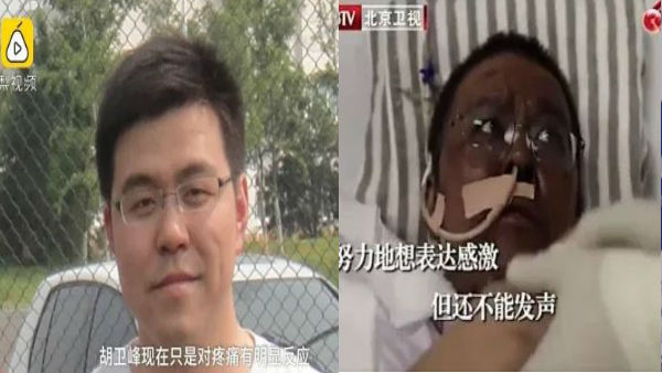  39 दिनों तक वेंटिलेटर पर रहे डॉक्टर