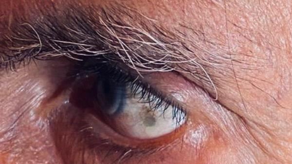 'एक काला धब्बा आंख के अंदर'