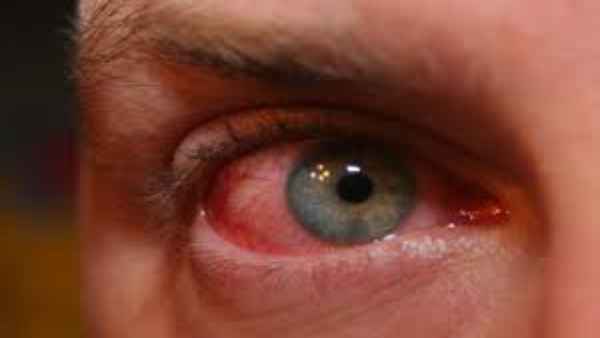 संक्रमण की वजह से कंजेक्टिवाइटिस हो सकता है