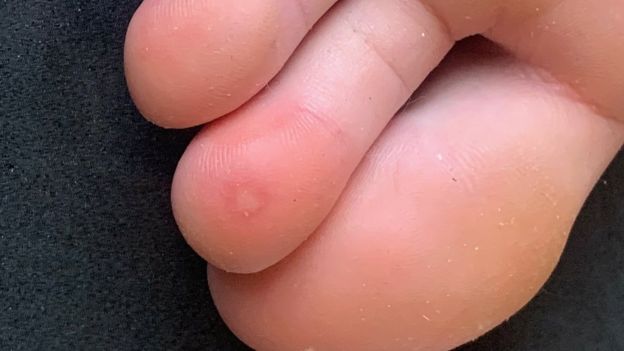 COVID-PIEL STUDY COVID-PIEL STUDY