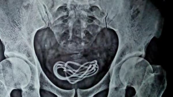 सफल रही सर्जरी