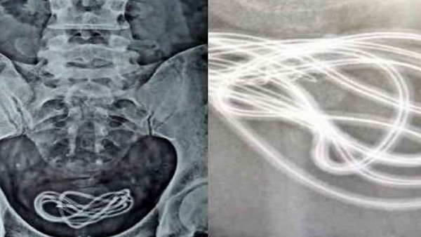 एक मीटर अंदर तक गया तार एक मीटर अंदर तक गया तार