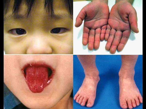 लक्षण और उपचार